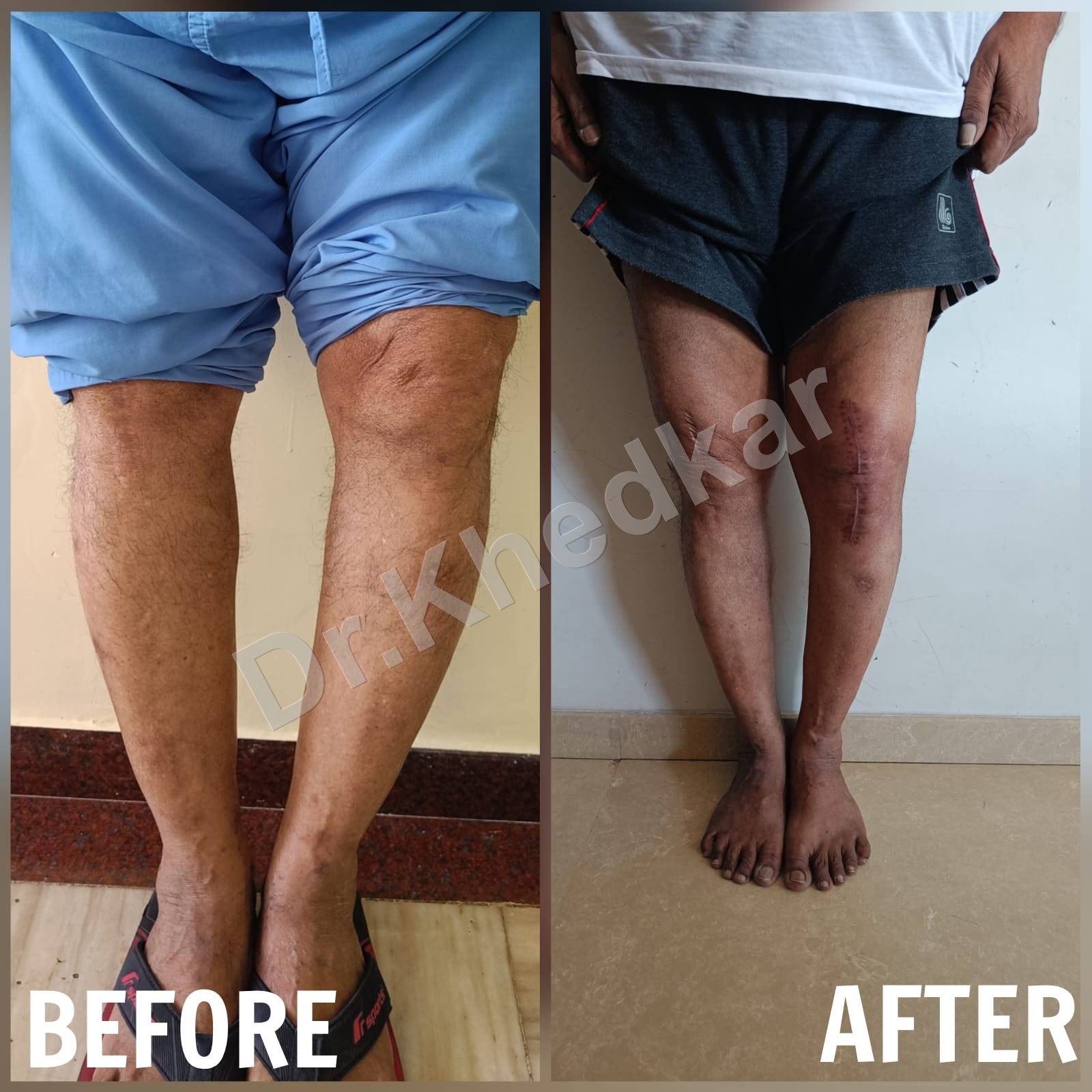 TKR patient care preview