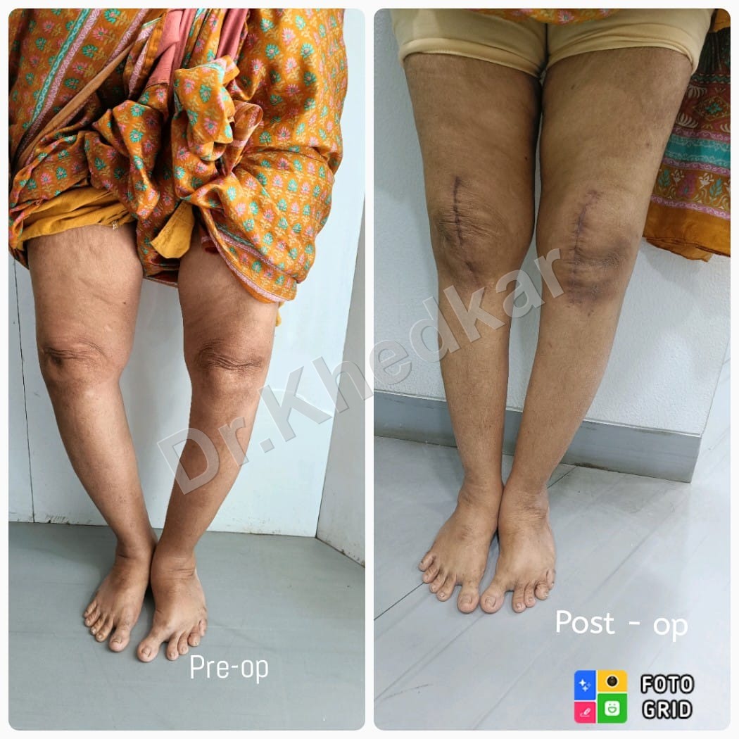 TKR procedure preview